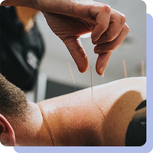 Man receiving acupuncture treatment